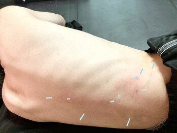 とだ鍼灸院/腰の横が痛い！体を起こせない！