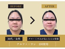 キレイ 筑紫野原田店(KIREI)/30代　クマ・くすみが気になる