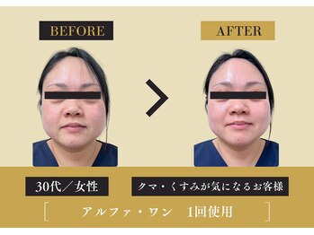 キレイ 筑紫野原田店(KIREI)/30代 クマ・くすみが気になる