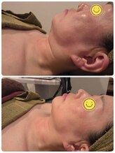 マハロ スコータイ/ビフォーアフター　＜小顔＞