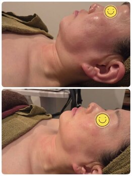 マハロ スコータイ/ビフォーアフター　＜小顔＞