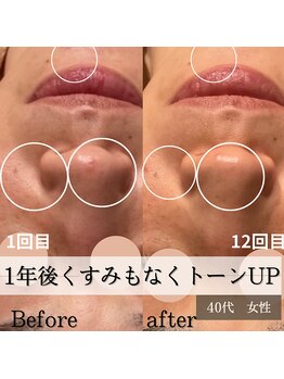 パルティノ 高崎店/1年間集中ケアで周りからも◎