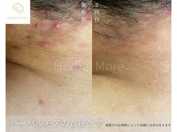 スキニティ 池袋(sknity)/<首>首元ポツポツ肌荒れ予防ケア