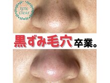 プラスボーテ(plus beaute)の雰囲気（鼻・頬の黒ずみ、ざらつきに。「毛穴ケア」）