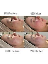 サロン ド ブラン アオヤマ(Salon de BLANC AOYAMA)/ニキビケアならお任せ