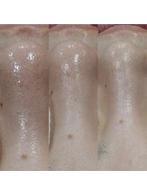 ボーソリューション(Beau-Solution)/【30代　毛穴の黒ずみ一発撃退】