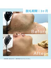 メンズクリア 松本店/【メンズクリア】お客様の施術例