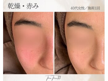 スリースリー(THREE THREE)/乾燥・赤みケア