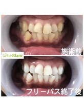 ルブラン 奈良店(Le Blanc)/3週間でどのくらい通うべき？