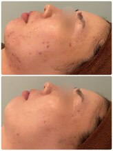 ビオプラス(BioPlus+)/ハーブピーリング /川崎