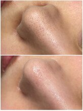 リリー 一宮店(Lily)/ハイドラフェイシャル