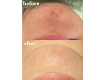 人気No.1☆効果重視のREVI陶肌トリートメント！肌悩みゼロへ◎