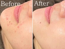 繰り返しのニキビもお任せください！