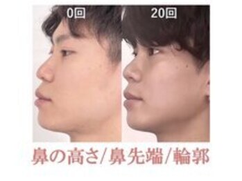 ラプリ 札幌ル・トロワ店/隆鼻＋輪郭矯正40分20回