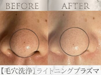 ビー(Be.)の写真/【毛穴汚れ・黒ずみ対策】肌質改善をしたい方やお肌トラブルを改善したい方に！お顔の肌トーンアップにも◎