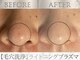 ビー(Be.)の写真/【毛穴汚れ・黒ずみ対策】肌質改善をしたい方やお肌トラブルを改善したい方に！お顔の肌トーンアップにも◎
