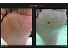 ドクターネイル爪革命 江戸川橋店/魚の目のケアは十八番です