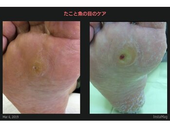 ドクターネイル爪革命 江戸川橋店/魚の目のケアは十八番です