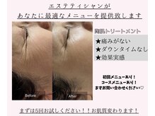 ビューティリュクス(beauty luxe)/REVIハーブピーリング