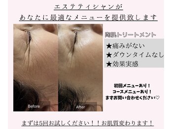 ビューティリュクス(beauty luxe)/REVIハーブピーリング