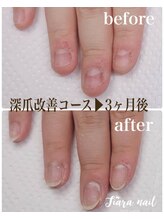 ティアラネイル 宇都宮/リプロネイル深爪矯正コース