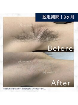 メンズクリア 藤沢OPA店/【メンズクリア】お客様の施術例