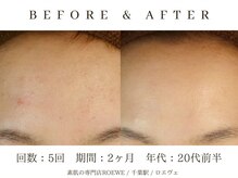 ロエヴェ(ROEWE)/ニキビ改善・毛穴ケア・肌質改善