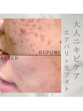 美バリ 新宿店(美BARI)/エアバリ×光フォト　4回