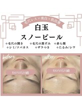 あらゆる毛穴悩みに☆白玉スノーピール