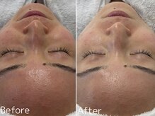 ドゥーウィー(Dewy)の雰囲気（40代女性/角質肥厚、開き毛穴ケア毛穴洗浄×ハーブピーリング）