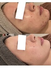 ミベル(MeBell)/【ハーブリプロ】ニキビ肌質改善