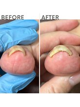 クオッカ(Quokka)/巻き爪ケア