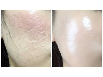 ソリッジ肌管理室/ニキビケア・毛穴ケア