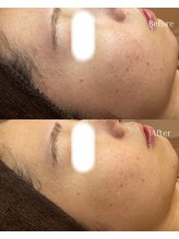 ベリスユイット(BELLIS HUIT)/【剥離ありハーブピーリング】