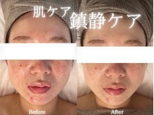 アールエーサロン 恵比寿 広尾(Ra salon)の雰囲気(他店の施術でバリア機能が崩れてしまった方の鎮静ケア/1回の変化)