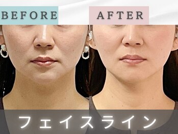 エルシンメトリー矯正院(ailesシンメトリー矯正院)/before＆after　ailes式小顔矯正