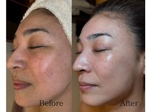 肌管理スタートして6ヶ月の結果写真になります。