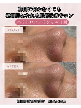 ホワイトラボ 梅田(White labo)/【施術例】ハイドロフェイシャル