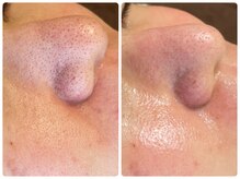 ラヴィ(Ravi)/いちご鼻改善