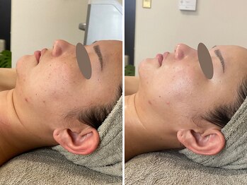 カプリス(CAPRiCE)/BBLフェイシャル