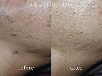 アート ビューティールーム(art beauty room)/☆OPL 光フェイシャル＆ハーブ