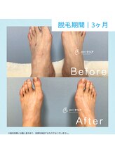 メンズクリア 松本店/【メンズクリア】お客様の施術例