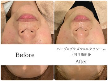 ラ セルフィー(Ra Selfee)/ハーブ×プラズマ×エクソソーム