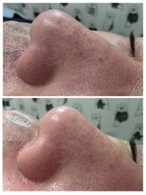 アンジェリーナ/毛穴洗浄/メンズ美容