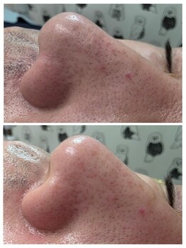 アンジェリーナ/毛穴洗浄/メンズ美容