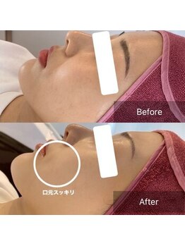 サンサンゴビューティー(335beauty)/リブセラ/施術回数1回