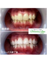 ホワイトニングサロン 名古屋駅店/【ホワイトニング施術例】