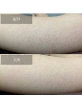 エクラルム(Eclaleum)/BeforeAfter　二の腕ピーリング