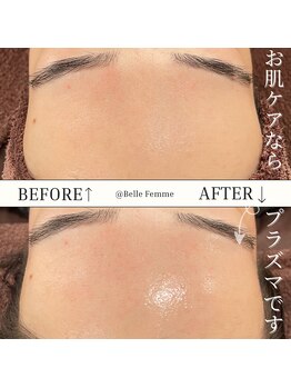 ベルファーム(Belle Femme)/お肌ケアならプラズマシャワー☆