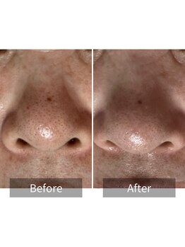 ヒヨリ(hiyori)/《before/after》毛穴洗浄